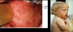-Measles
-Koplik spots show up early in the infection.
