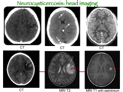 -Head imaging of cysticercosis.
-No real issue when they're alive.
-Edema and inflammation is what causes seizures.
-Can be focal or diffuse.
-Calcifies in late stage, after cysts die.