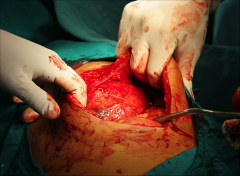 Hydatid cyst being removed from the liver.