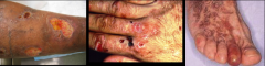 left to right:
Polyarteritis nodosa, Porphyria cutanea tarda, Mixed cryoglobulinemia