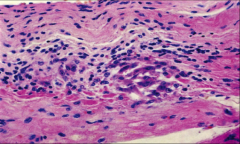 -A cellular reaction pattern consisting of lymphocytes and macrophages aggregated around fibrinoid deposits is found in human hearts. This lesion, called the Aschoff body, is considered characteristic of rheumatic carditis.