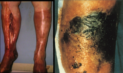*Left: Myonecrosis; the most severe form of damage from C. perfringens.

*Clostridia can be introduced into tissue during surgery or by a traumatic injury.