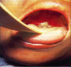 pseudomembrane in the back of the throat as a result of Corynebacterium diphtheriae infection.