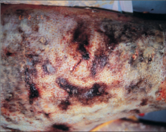Burn infection from pseudomonas aeruginosa.