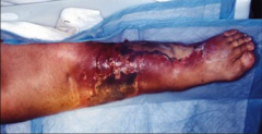 Ecthyma gangrenosum: bacterial infection caused by P. aeruginosa that results in black necrotic lesions; usually in immunocompromised