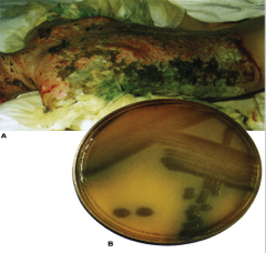 Pseudomonas aeruginosa: The blue color of pyocyanin when mixed with yellow tissue or media components typically produces a green discoloration. This is sometimes seen in clinical cases  and on culture plates.