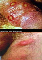 *Sexually transmitted bacterial infection.
*Highly infectious and can invade on contact.
*Major ulcerative disease in tropical and subtropical regions.
*Lesions on skin and mucous membranes can progress to become ulcers with inguinal lymphadenopathy (b