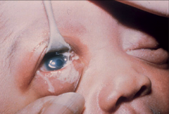 Gonococcal ophthalmia neonatorum. Lid edema, erythema, and marked purulent discharge are seen. A Gram-stained smear would reveal abundant organisms and inflammatory cells.