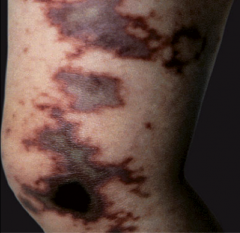 *Meningococcemia. Note purpuric lesions on leg caused by endotoxin-mediated disseminated intravascular coagulation (DIC)