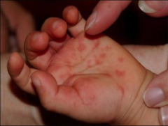 *Encompass Coxsackie, echovirus, other non-poliovirus enteroviruses
*Causes 6-10% of cases of viral meningitis in the winter and spring despite being more common in late summer and fall
*Rash, diarrhea, and upper respiratory symptoms may also be present