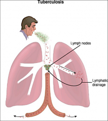 *Spread via aerosol droplet nuclei from patients with active pulmonary TB.
*Brief encounters pose limited risk; usually repeated or prolonged contact is required for transmission. 
*Initial multiplication is in the alveoli with spread through lymphatic 