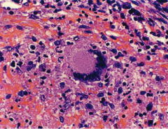 The response to TB manifests in the formation of a granuloma.