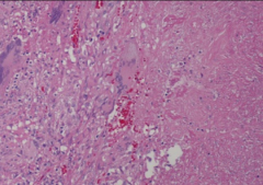 DTH in response to TB leads to caseous necrosis in the center of the lesion.
