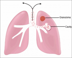 *Dormant TB reactivation typically starts in the upper lobes of the lung (more oxygen up there) with granuloma formation. 
*DTH-mediated destruction can form a cavity, which allows the organisms to be coughed up to infect another person.
*Have to immune