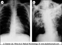 Chest radiographs of (a) primary tuberculosis, showing the Ghon focus in the lower left lung, and (b) post-primary pulmonary tuberculosis showing advanced disease.