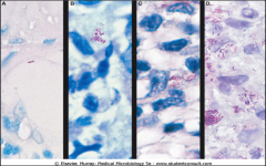 Mycobacterium leprae. Acid-fast stains of skin biopsies from patients with (A) tuberculoid leprosy, (B) borderline tuberculoid leprosy, (C) borderline lepromatous leprosy, and (D) lepromatous leprosy. Note that there is a progressive increase in bacteria 