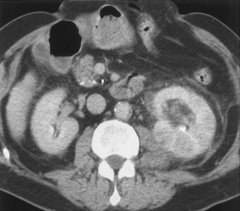 *Acute pyelonephritis. CT scan obtained with intravenous contrast material reveals patchy enhancement of the left kidney. The kidney is minimally enlarged with perinephric stranding, secondary findings that also suggest infection.