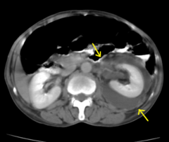 *Perinephric abscess on a CT scan - appears as a soft-tissue mass with a thick wall that may enhance after introduction of intravenous contrast material.
*complication of pyelonephritis
*can't be treated with meds alone
