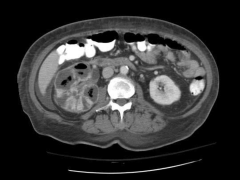 *Emphysematous pyelonephritis 
*Presence of gas in the urinary tract tissue
*Associated with diabetes and urinary tract obstruction
*Severe cases may require percutaneous drainage or surgical debridement