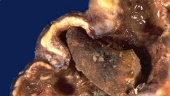 *"Staghorn calculus". Seen here is a horn-like stone extending into a dilated calyx, with nearly unrecognizable overlying renal cortex from severe hydronephrosis and pyelonephritis. 
*Nephrectomy may be performed because the kidney is non-functional and 