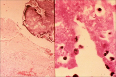 left: strep visible
right: gram neg diplococci (gonorrhea)

*both on heart valves