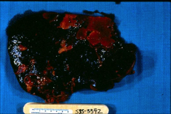 *lighter colored scabs are infarcts to the spleen, 2˚ to endocarditis.