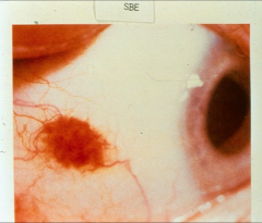 *scleral hemorrhage due to endocarditis