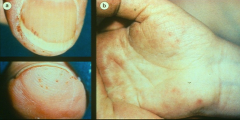 *left: petechiae, splinter hemorrhages
*right: janeway lesions