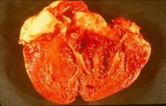 *aortic valve completely destroyed by s. aureus