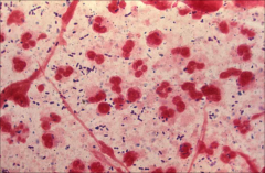 Gram pos diplococci visible; chains visible
-Strep. pneumoniae