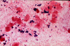 *sputum gram stain showing s. aureus (often acquired 2˚ to influenza)
