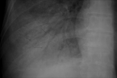 *air bronchogram indicating bacterial pneumonia
*black arrows indicating air