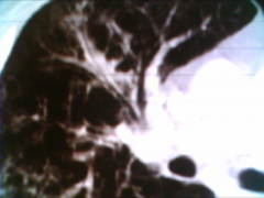 *CT scan
*air bronchogram; showing air in the airways that aren't involved in the infection.