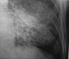 *Xray showing interstitial pneumonia.