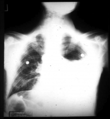 *ask pt to lie on side--> if fluid laters out, it's a pleural effusion!