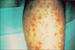*Benign infection of hair follicle
*Raised, painful, erythematous lesions
*Central pustule; org can be cultured
*Absent constitutional symptoms
*S. aureus; Pseudomonas in hot tubs
*Rx: topical/systemic + hygiene