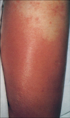 Uncomplicated cellulitis