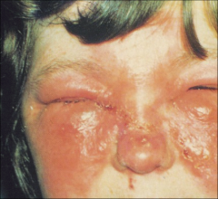 *Superficial, involves cutaneous lymphatics (dermis)
*Areas of preexisting lymphatic obstruction/edema
*Extremities>>face
*Constitutional symptoms
*S. pyogenes >>other strep and S. aureus
*Margins are raised and well-demarcated
*Rx: antimicrobials
