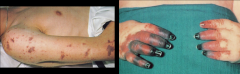 Cutaneous Manifestation of Systemic Infection: Meningococcemia