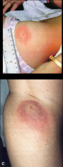 rash in Lyme disease