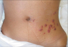 What immune defect predisposes to this infection?


How could this infection have been prevented in a patient after allogeneic bone marrow transplantation?