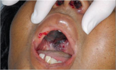 37 yo female with relapsed AML undergoing re-induction
chemotherapy. Developed nosebleeds and intraoral lesion.