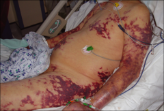 47 yo m presents with sepsis and the skin findings depicted in the photograph.

What might be the patient’s underlying Immune defect?

Would this infection have been preventable?