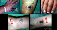 Cutaneous Anthrax
-dense, woody, indurated edema