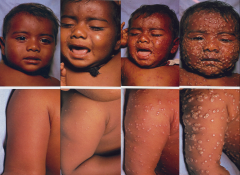 -smallpox progression
-day 2, 3, 5, and 8