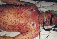 Hemorrhagic Smallpox