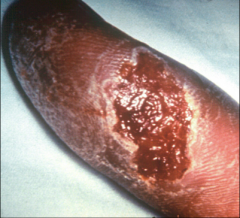 Patient with ulceroglandular tularemia