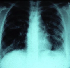 Chest radiograph of patient with pulmonary tularemia
(Radiograph shows bilateral pneumonitis and left pleural effusion)