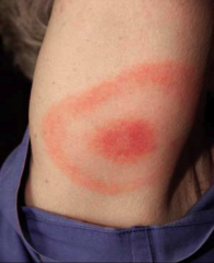 Lyme Disease: Erythema Migrans
