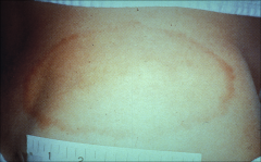 LYME DISEASE: ERYTHEMA MIGRANS
*rash is fading; size is variable
*also present with fever, chills, stiff neck